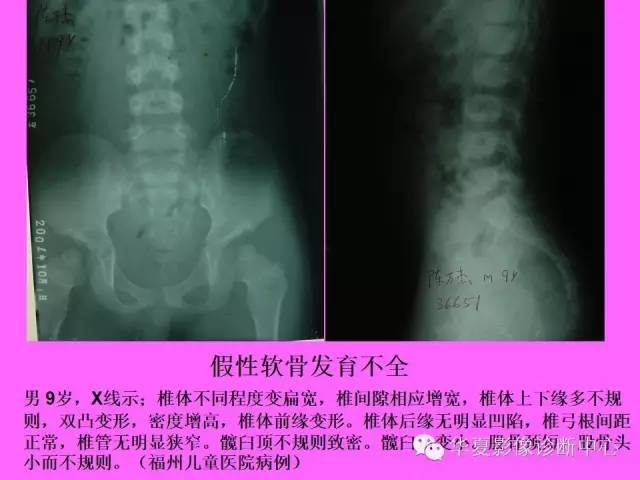 【PPT】骨发育障碍的影像学诊断