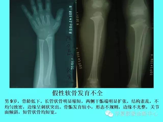 【PPT】骨发育障碍的影像学诊断