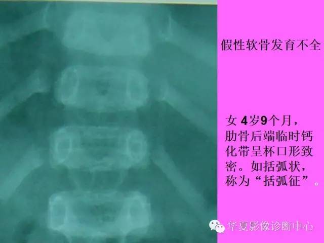 【PPT】骨发育障碍的影像学诊断
