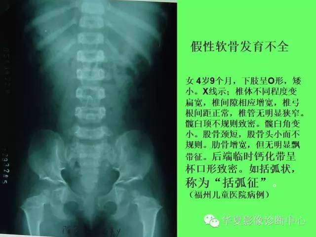 【PPT】骨发育障碍的影像学诊断