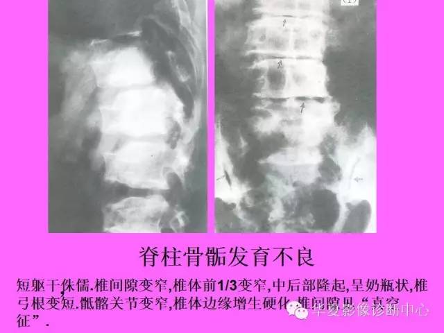 【PPT】骨发育障碍的影像学诊断
