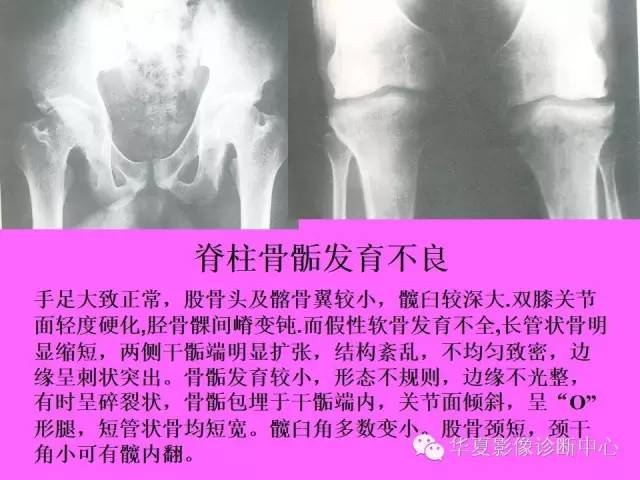 【PPT】骨发育障碍的影像学诊断
