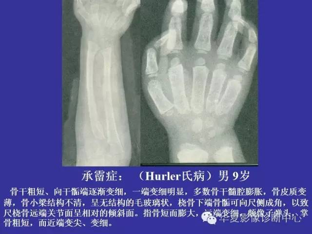 【PPT】骨发育障碍的影像学诊断