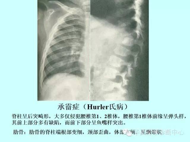 【PPT】骨发育障碍的影像学诊断