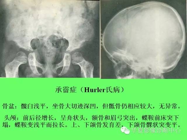 【PPT】骨发育障碍的影像学诊断
