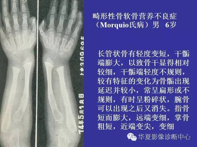 【PPT】骨发育障碍的影像学诊断