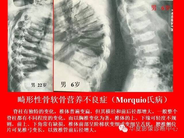 【PPT】骨发育障碍的影像学诊断