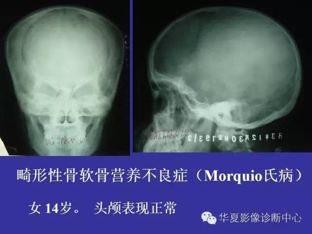 【PPT】骨发育障碍的影像学诊断
