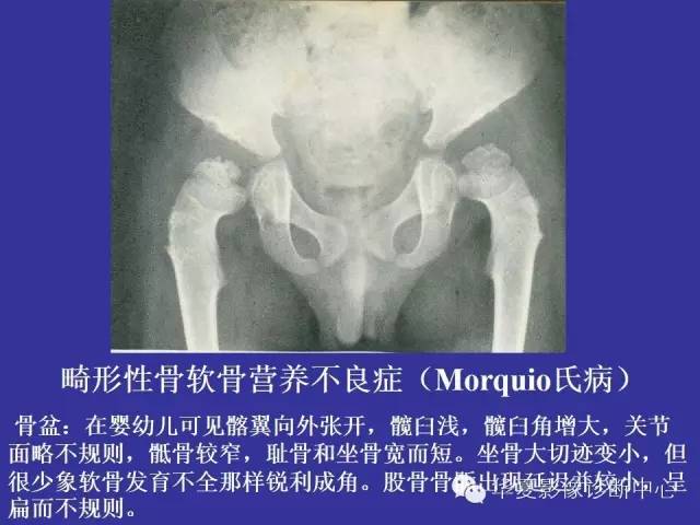 【PPT】骨发育障碍的影像学诊断