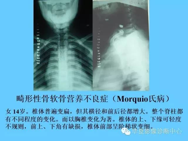 【PPT】骨发育障碍的影像学诊断