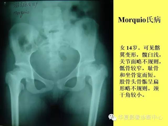 【PPT】骨发育障碍的影像学诊断