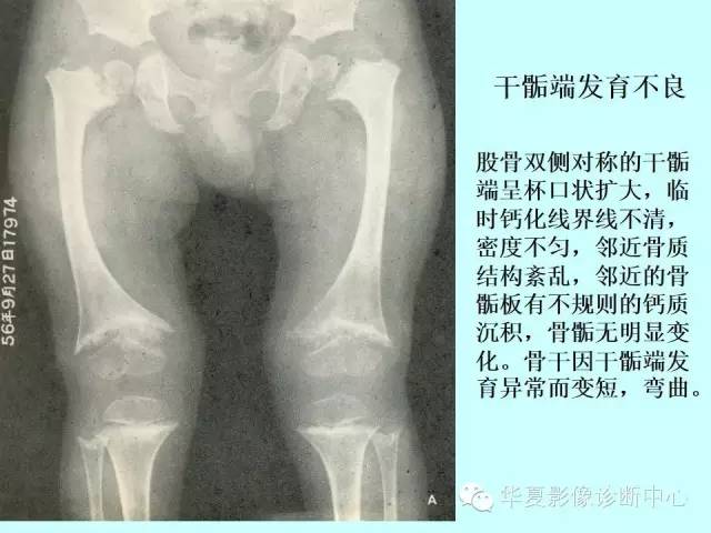 【PPT】骨发育障碍的影像学诊断