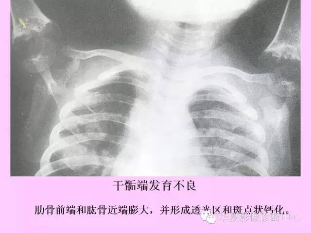【PPT】骨发育障碍的影像学诊断