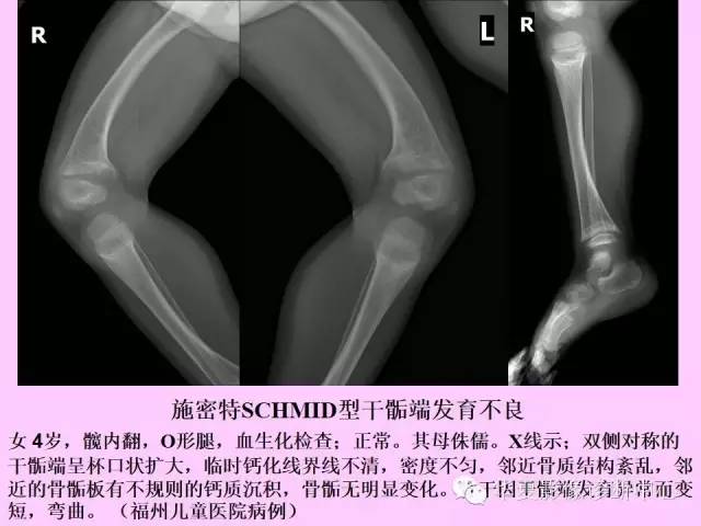【PPT】骨发育障碍的影像学诊断