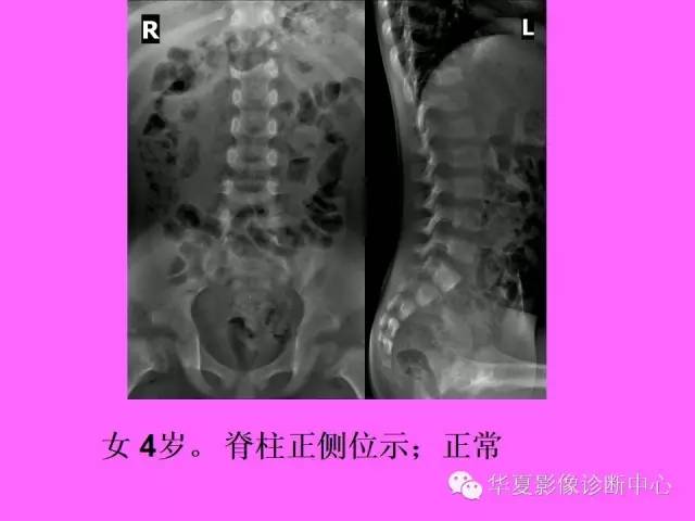 【PPT】骨发育障碍的影像学诊断