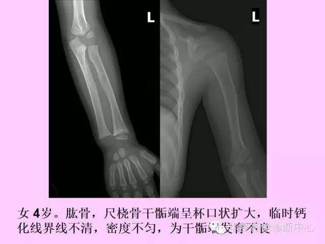 【PPT】骨发育障碍的影像学诊断