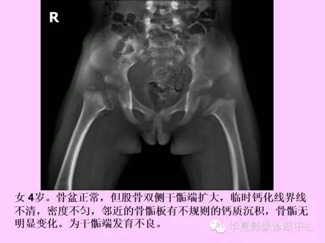 【PPT】骨发育障碍的影像学诊断