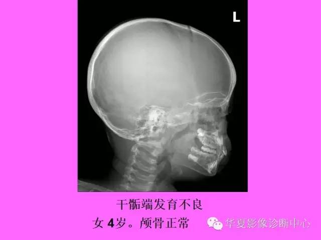 【PPT】骨发育障碍的影像学诊断