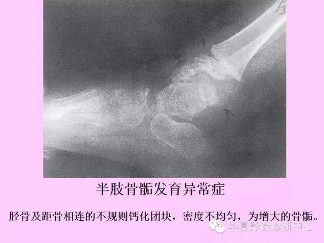 【PPT】骨发育障碍的影像学诊断