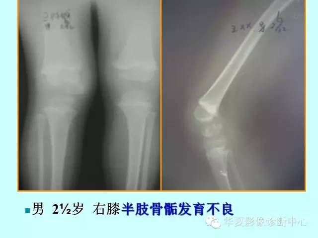 【PPT】骨发育障碍的影像学诊断
