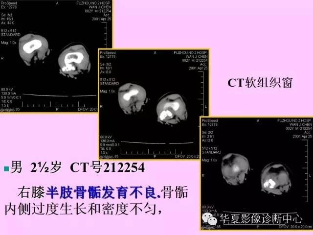 【PPT】骨发育障碍的影像学诊断