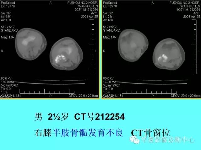 【PPT】骨发育障碍的影像学诊断