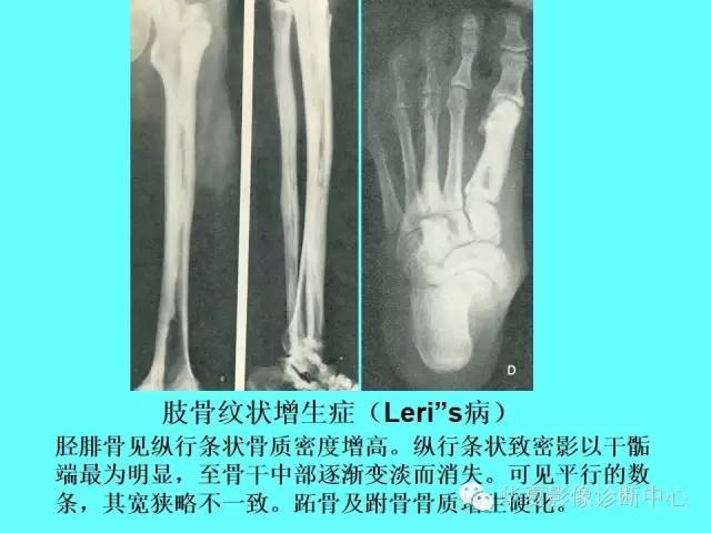 【PPT】骨发育障碍的影像学诊断