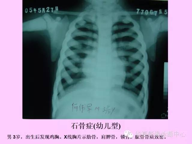 【PPT】骨发育障碍的影像学诊断