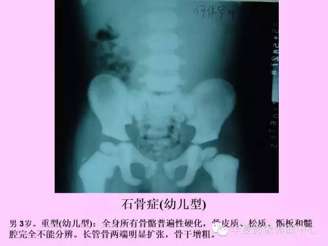 【PPT】骨发育障碍的影像学诊断