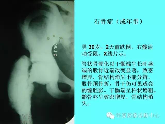 【PPT】骨发育障碍的影像学诊断