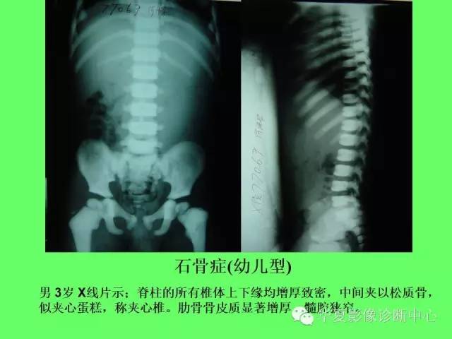 【PPT】骨发育障碍的影像学诊断