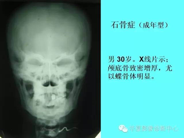 【PPT】骨发育障碍的影像学诊断