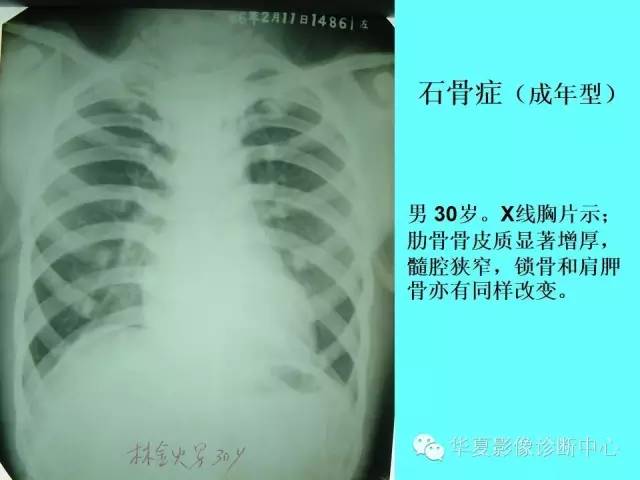 【PPT】骨发育障碍的影像学诊断