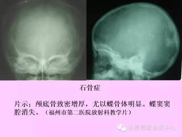 【PPT】骨发育障碍的影像学诊断