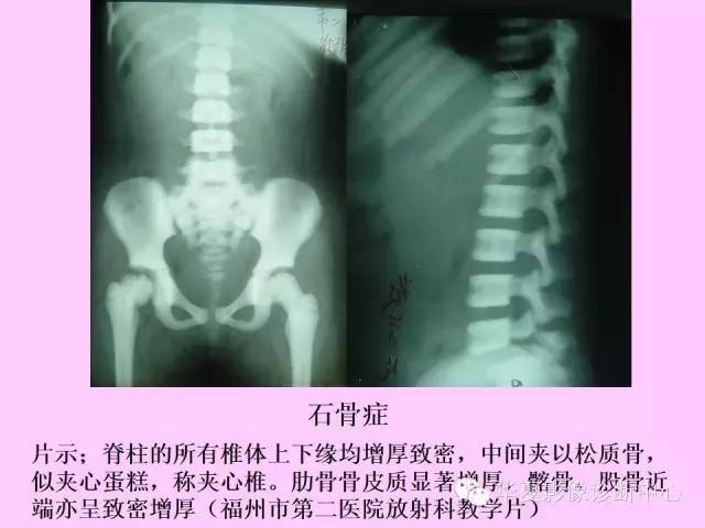 【PPT】骨发育障碍的影像学诊断