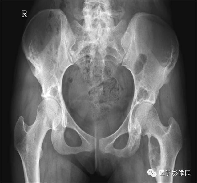 【病例】髂骨朗格汉斯细胞组织细胞增生症1例