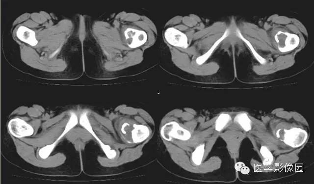 【病例】髂骨朗格汉斯细胞组织细胞增生症1例 【病例】髂骨朗格汉斯细胞组织细胞增生症1例