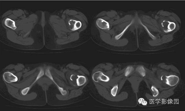 【病例】髂骨朗格汉斯细胞组织细胞增生症1例 【病例】髂骨朗格汉斯细胞组织细胞增生症1例