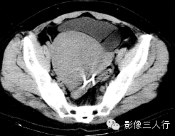 子宫常见疾病的鉴别诊断