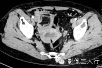 子宫常见疾病的鉴别诊断 子宫常见疾病的鉴别诊断