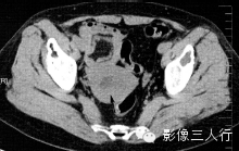 子宫常见疾病的鉴别诊断 子宫常见疾病的鉴别诊断
