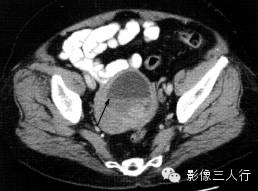 子宫常见疾病的鉴别诊断 子宫常见疾病的鉴别诊断
