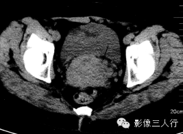 子宫常见疾病的鉴别诊断 子宫常见疾病的鉴别诊断