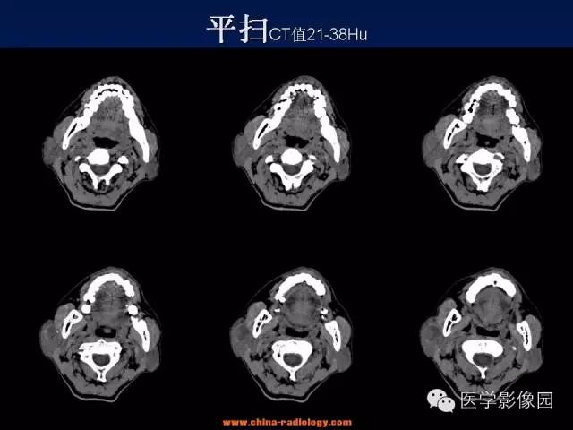 【病例】腮腺基底细胞腺瘤1例CT影像表现