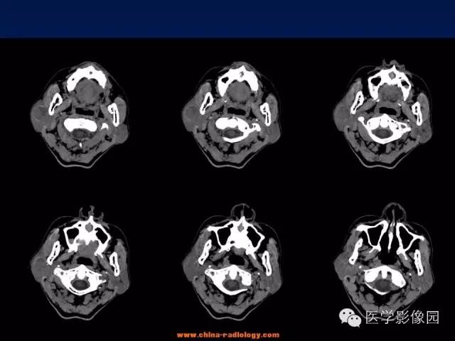 【病例】腮腺基底细胞腺瘤1例CT影像表现
