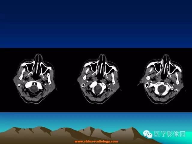 【病例】腮腺基底细胞腺瘤1例CT影像表现