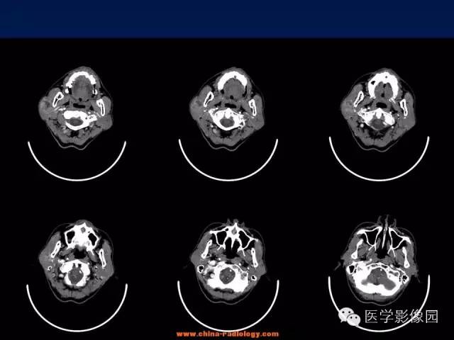 【病例】腮腺基底细胞腺瘤1例CT影像表现