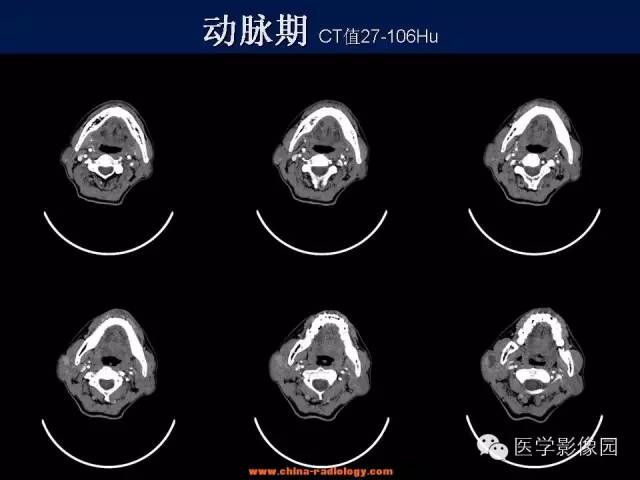 【病例】腮腺基底细胞腺瘤1例CT影像表现