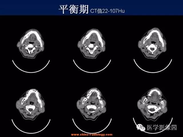 【病例】腮腺基底细胞腺瘤1例CT影像表现