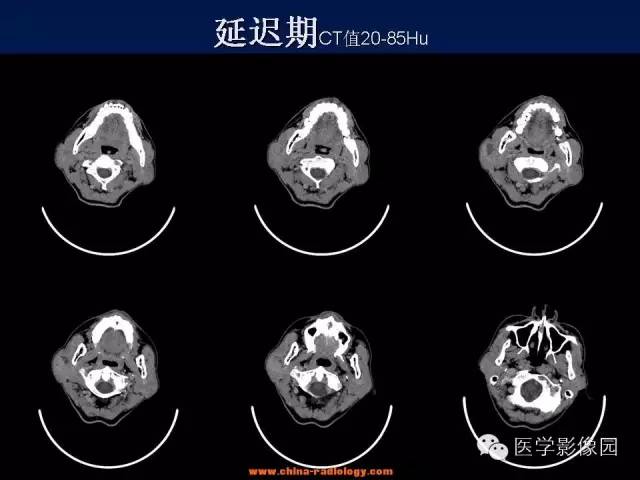 【病例】腮腺基底细胞腺瘤1例CT影像表现